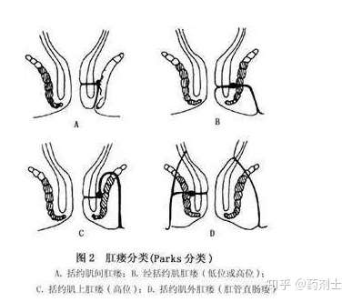 肛瘺的最新治療方法