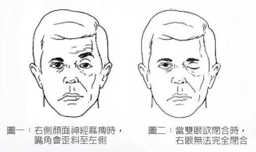 梅杰癥的最新治療方法研究